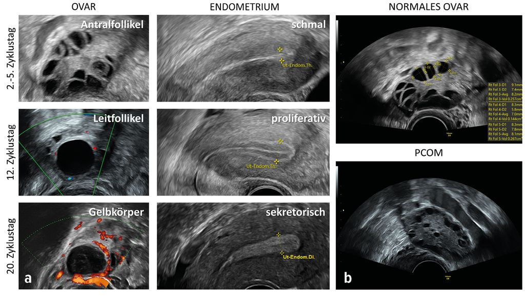 Sonografische Beurteilung der Fertilität Gynäkologie & Geburtshilfe Universimed Medizin im